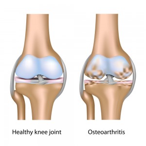 Arthritis_knee